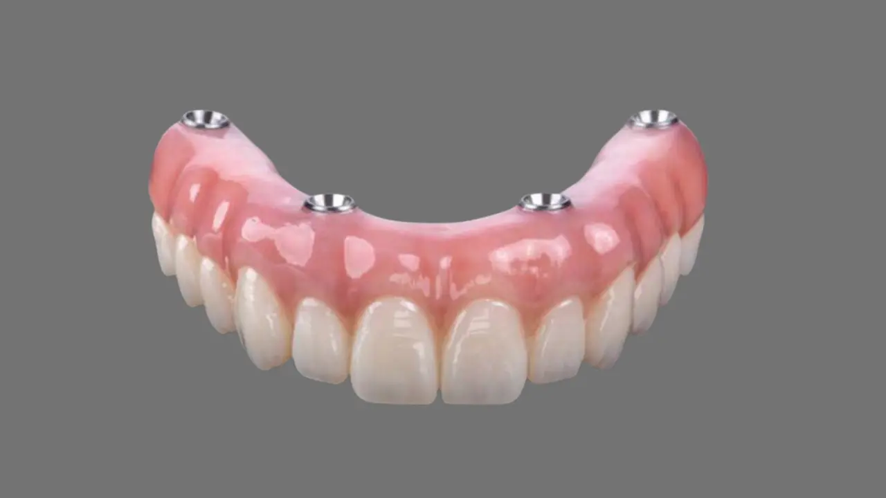 Single Tooth Dental Implants
