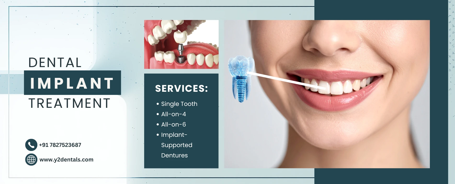 Dental Implants Clinic in Delhi