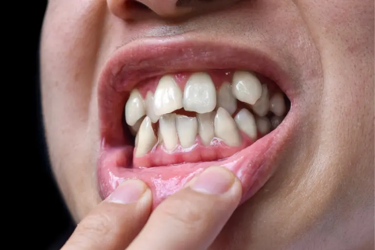 Unevenly Shaped Teeth